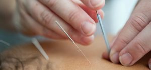 6 Common Conditions That Can Be Treated With Acupuncture